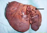 ovarian cancer symptomshigh pancreatic enzymes